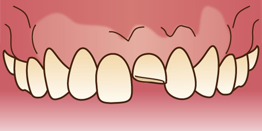 前歯のトラブル