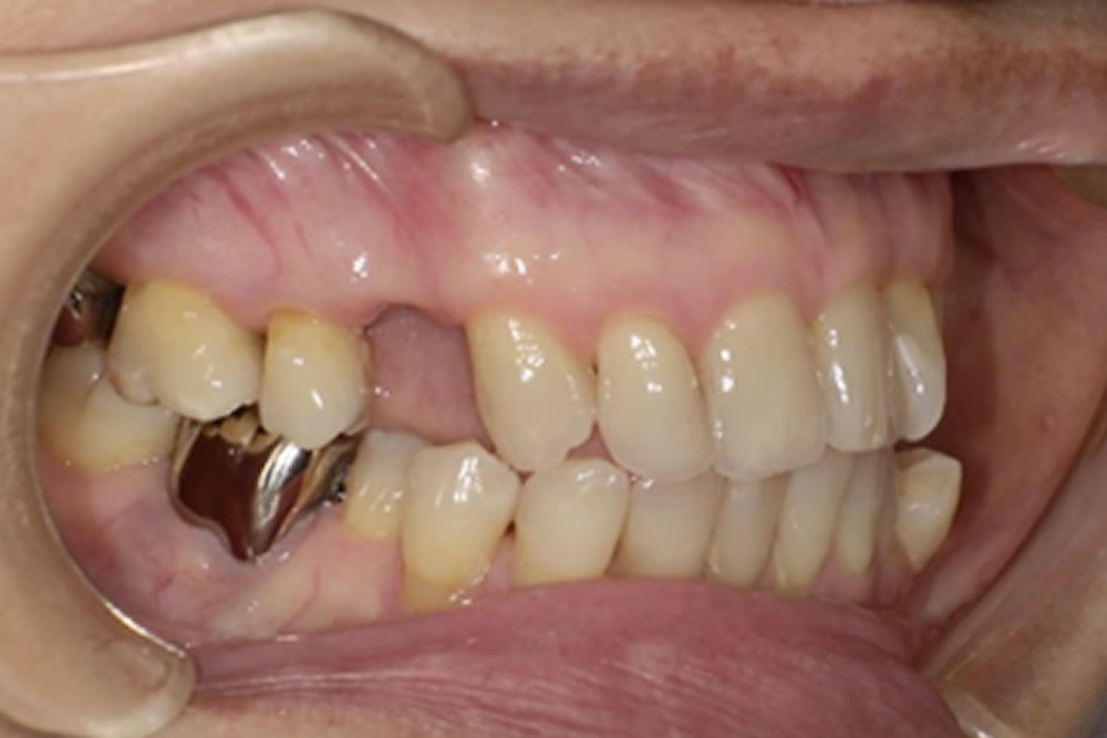 ミラクルデンチャー装着前