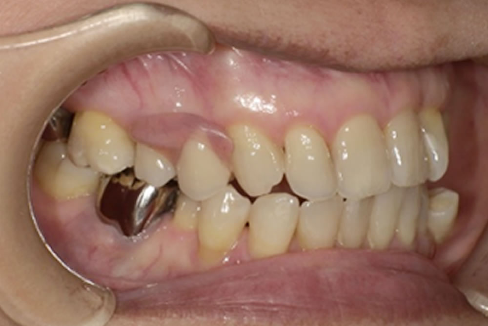 ミラクルデンチャー装着後