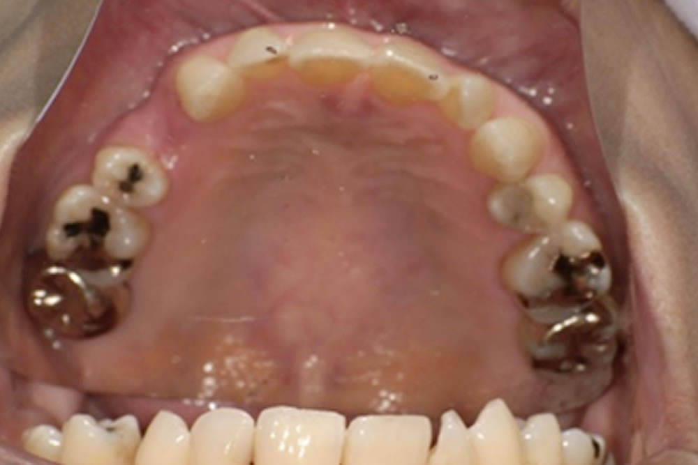 ミラクルデンチャー装着前