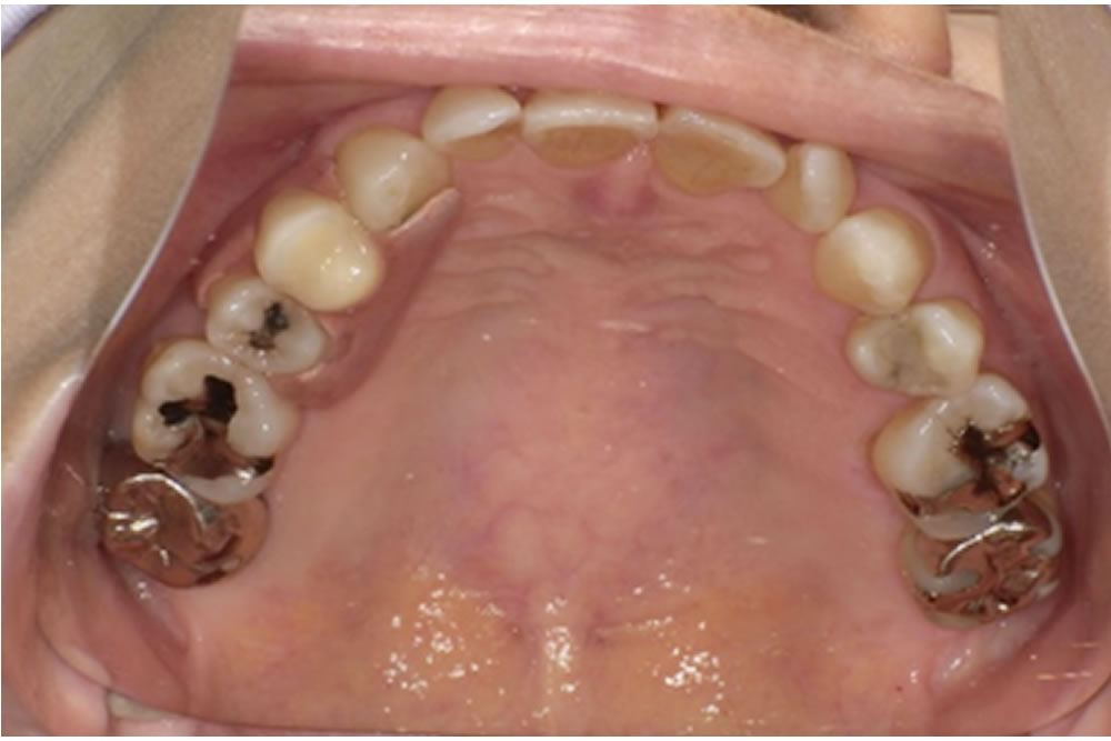 ミラクルデンチャー装着後