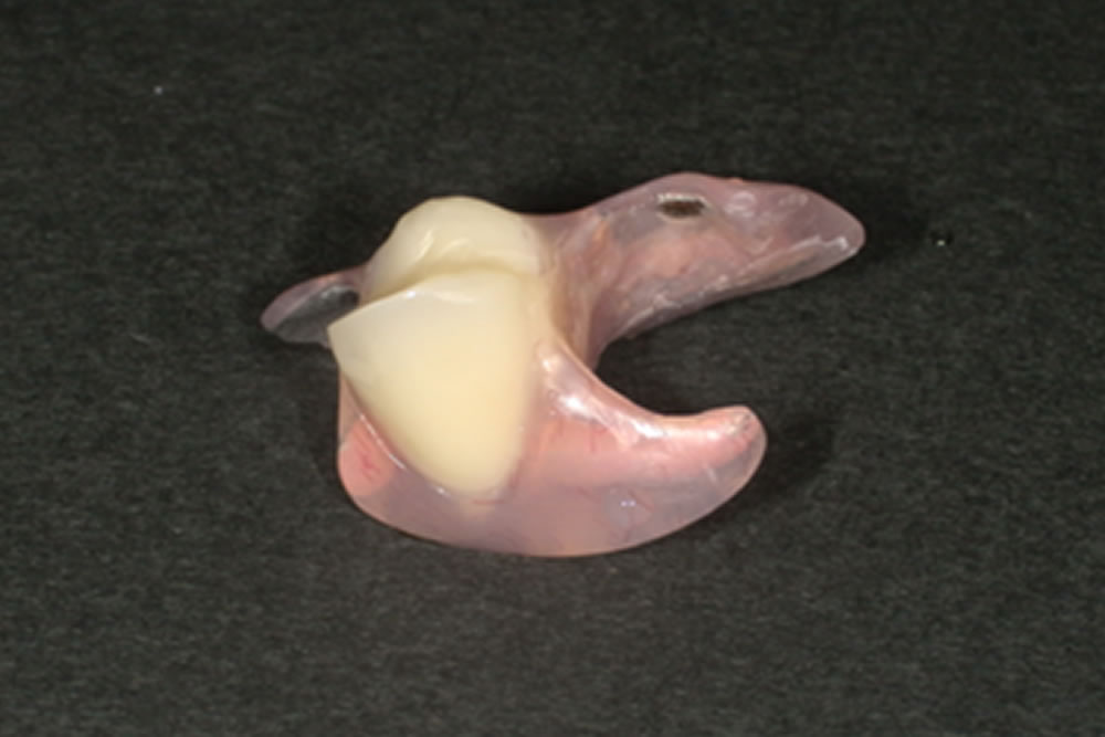 ミラクルデンチャー装着後