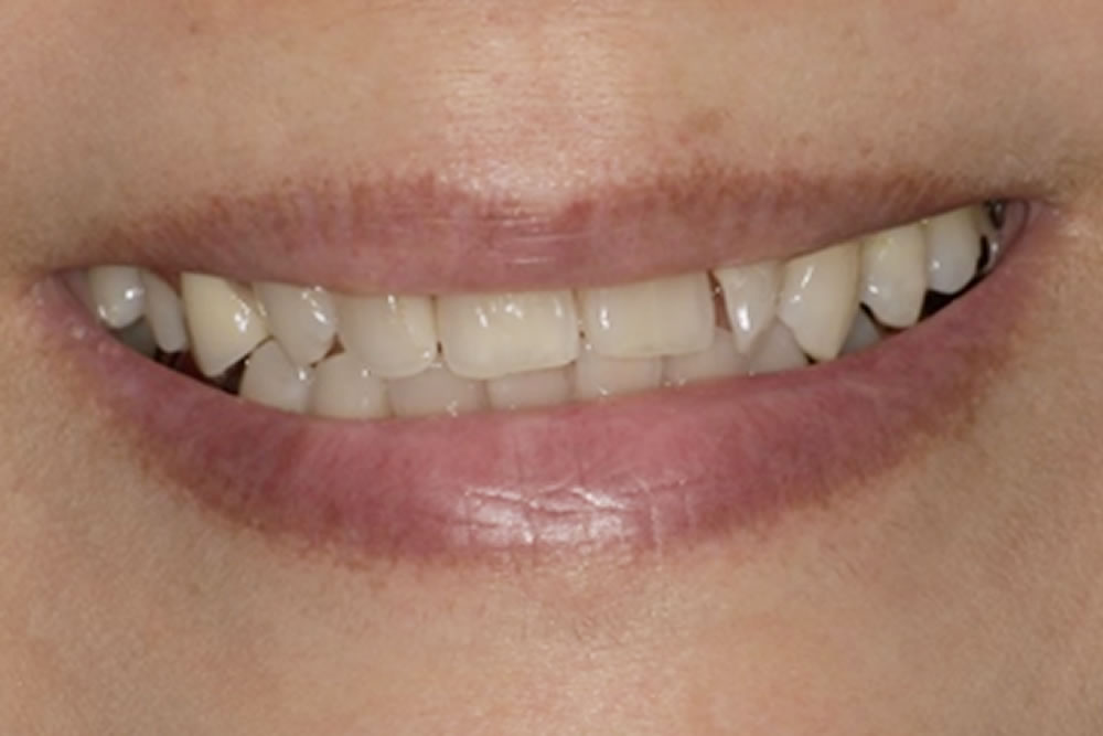 ミラクルデンチャー装着後