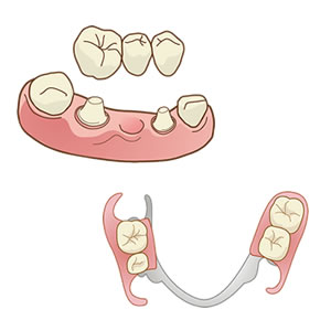 「入れ歯」と「ブリッジ」どちらがいいの?