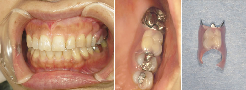 当院で実施した40代女性の入れ歯治療：ケース③