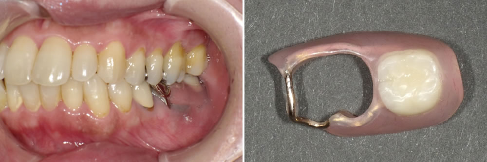 当院で実施した40代女性の入れ歯治療：ケース⑧